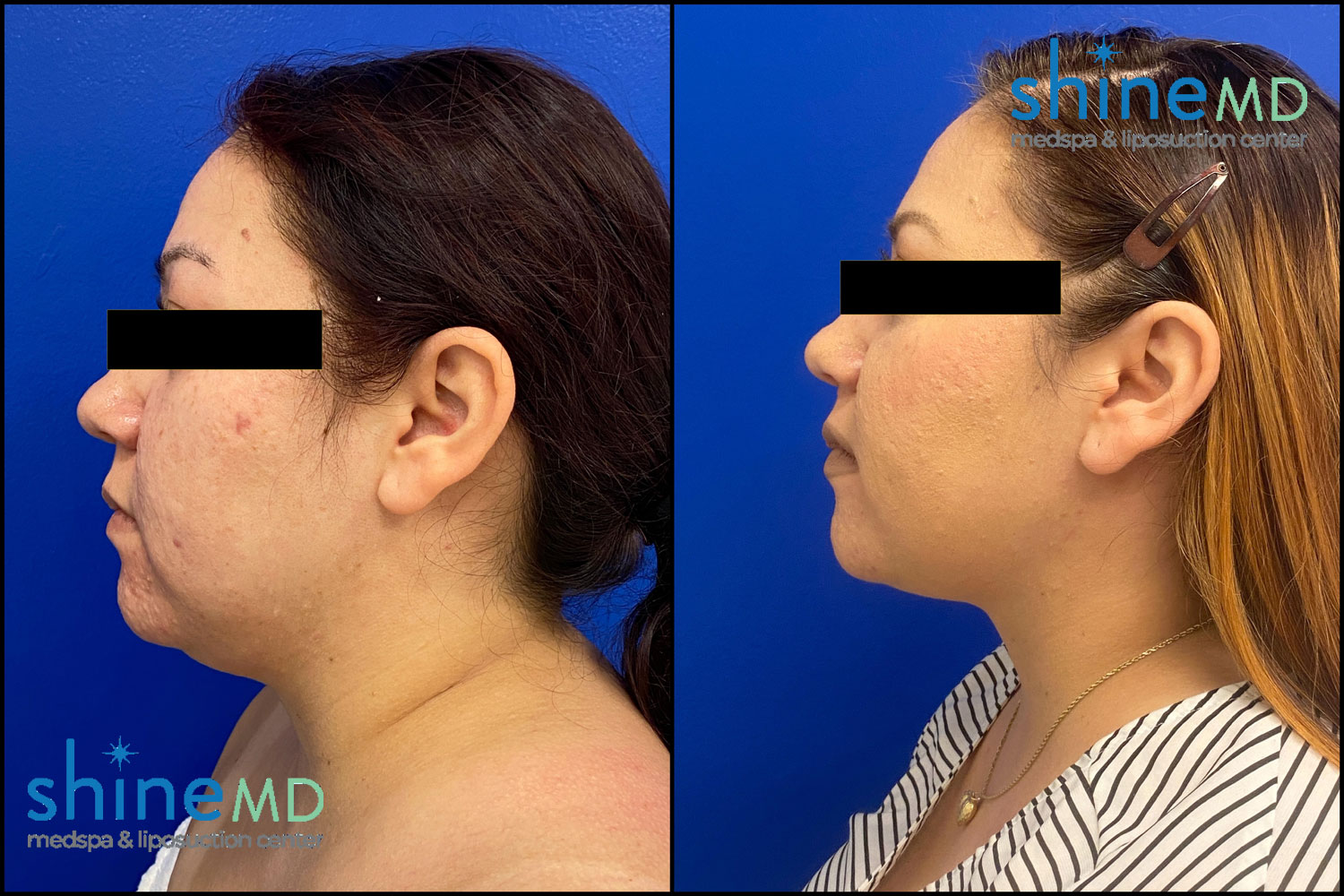 Chin lipo Before & After Photo