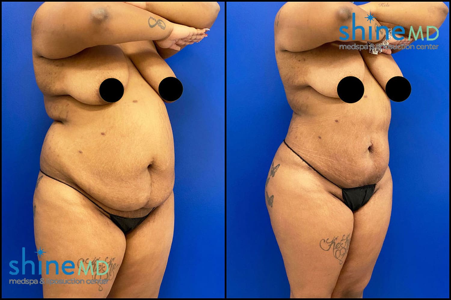 Body Countering before after patient photos