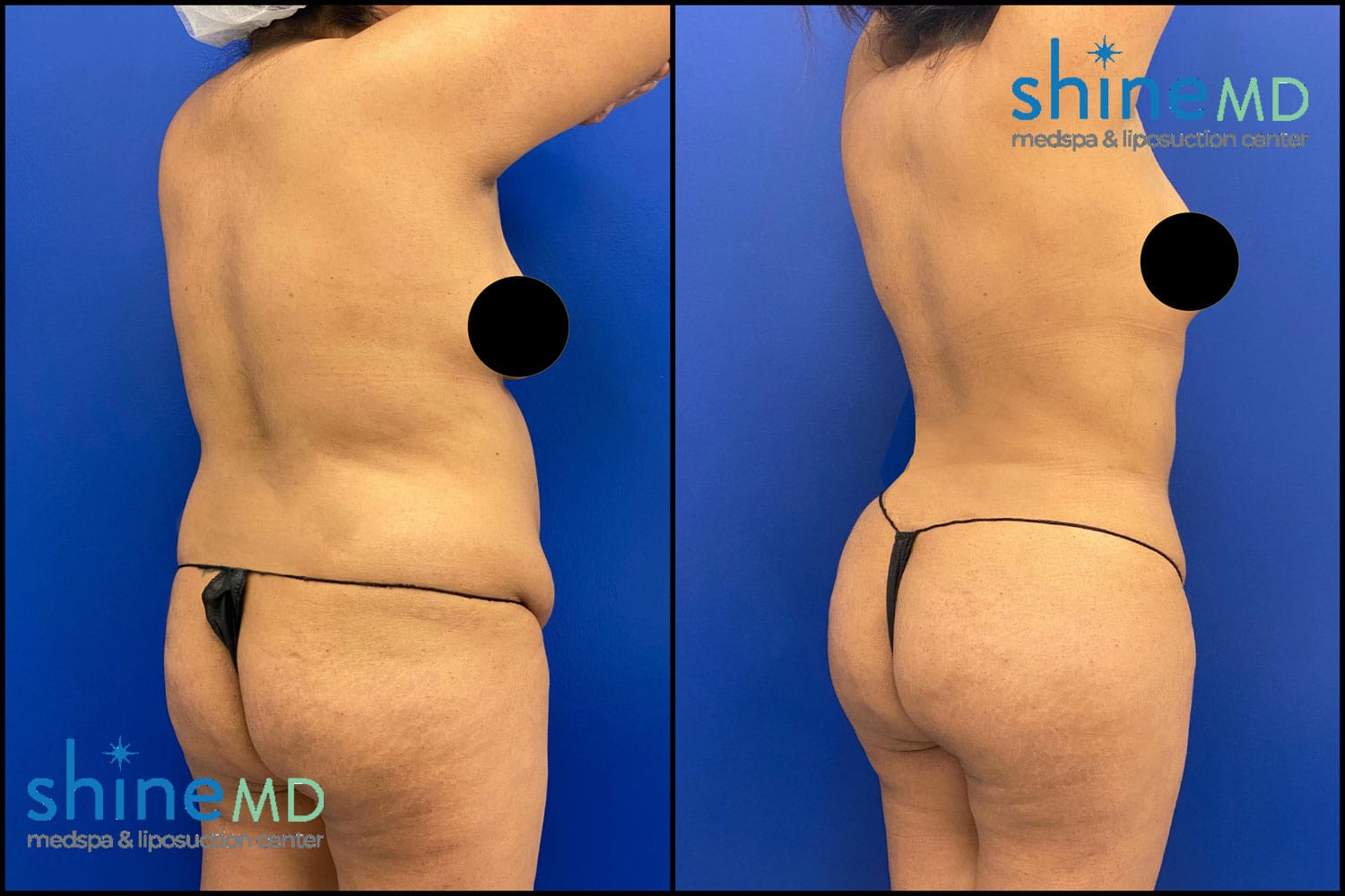 Before & After Photo Lipo360