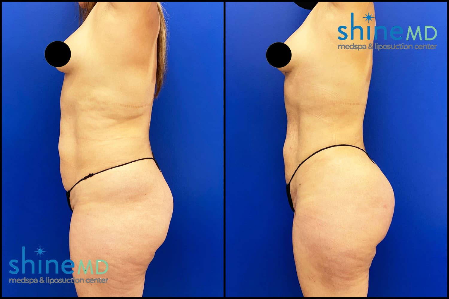 Lipo360 with BBL happy patients photos