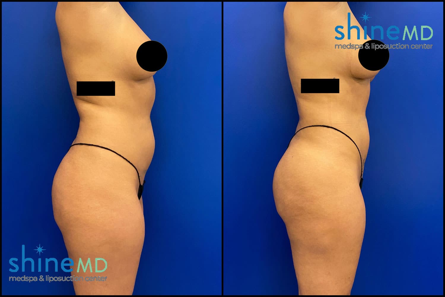 Lipo360 with BBL Before & After Picture