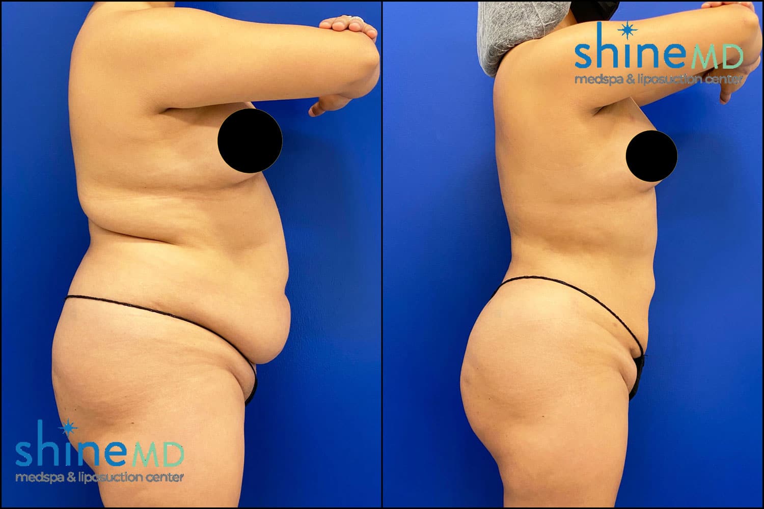Before After Photo of Lipo360