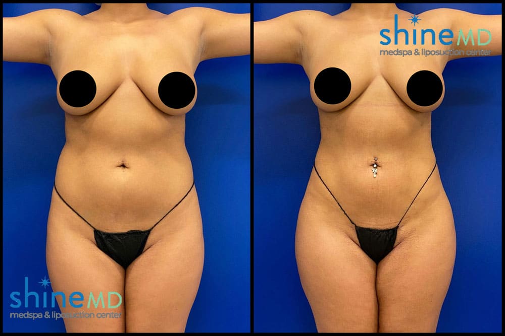 Liposuction before and after image