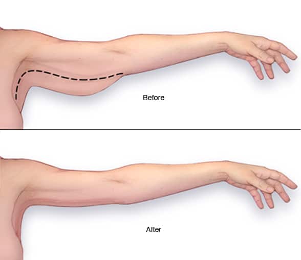 Arm-Lipo-before-and-after