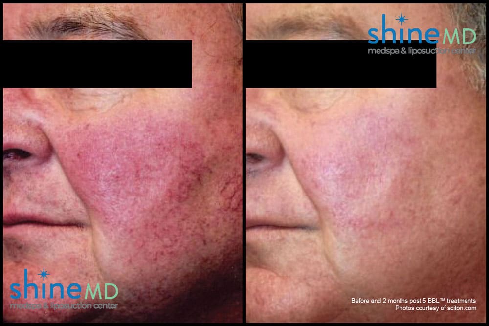 bbl skin rejuvenation before and after photos