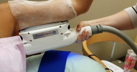 What is CoolSculpting arms and how does it work?