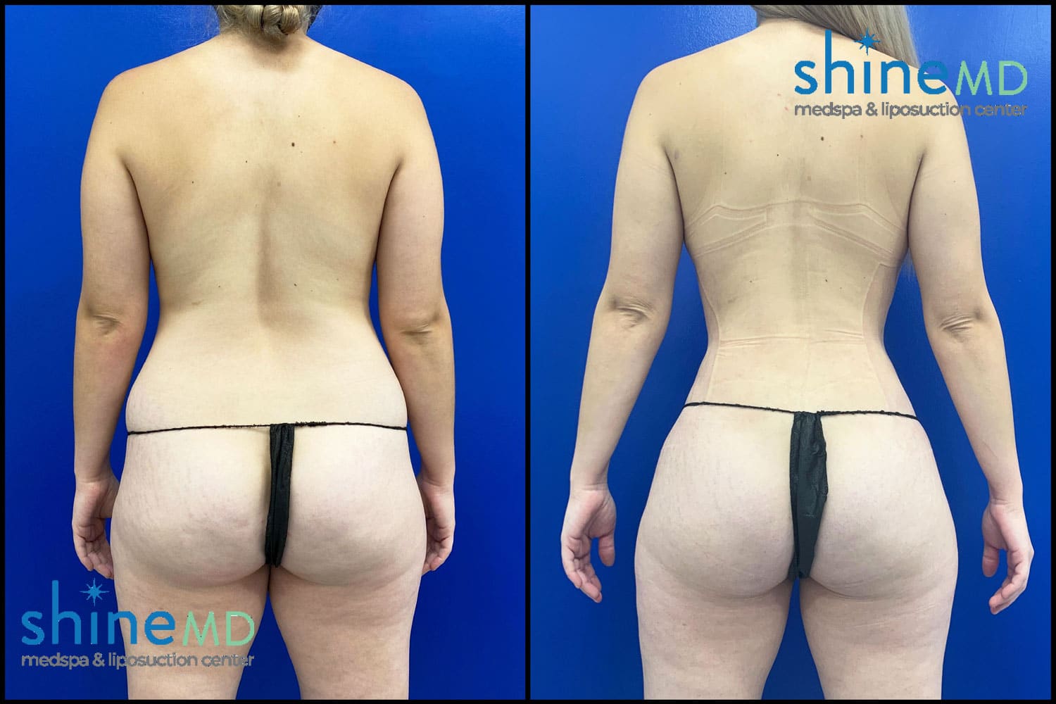 Vaser lipo 360 with BBL photos back view patient 2316689
