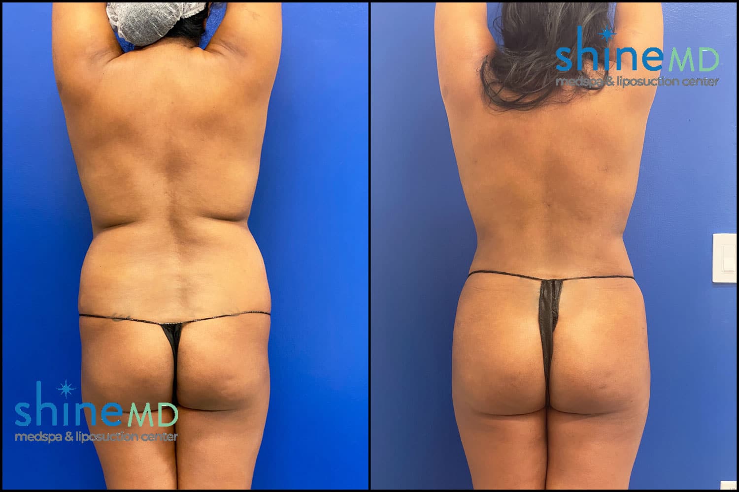bbl with lipo 360 before and after photos