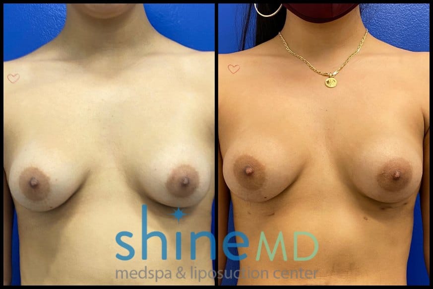 Breast augmentation with fat transfer patient 1362204