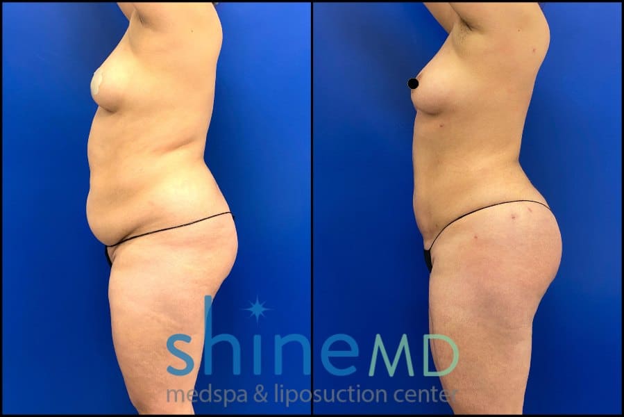 Lipo 360 with BBL Photos of Patient 2316689 side view