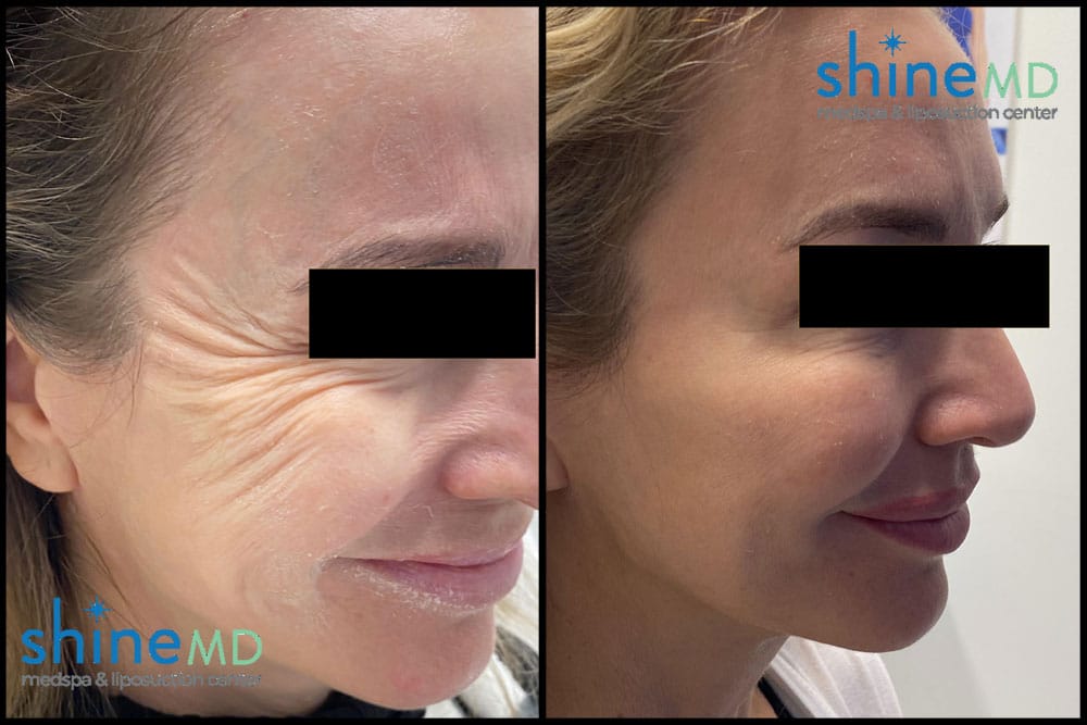 coolsculpting chin before and after 2