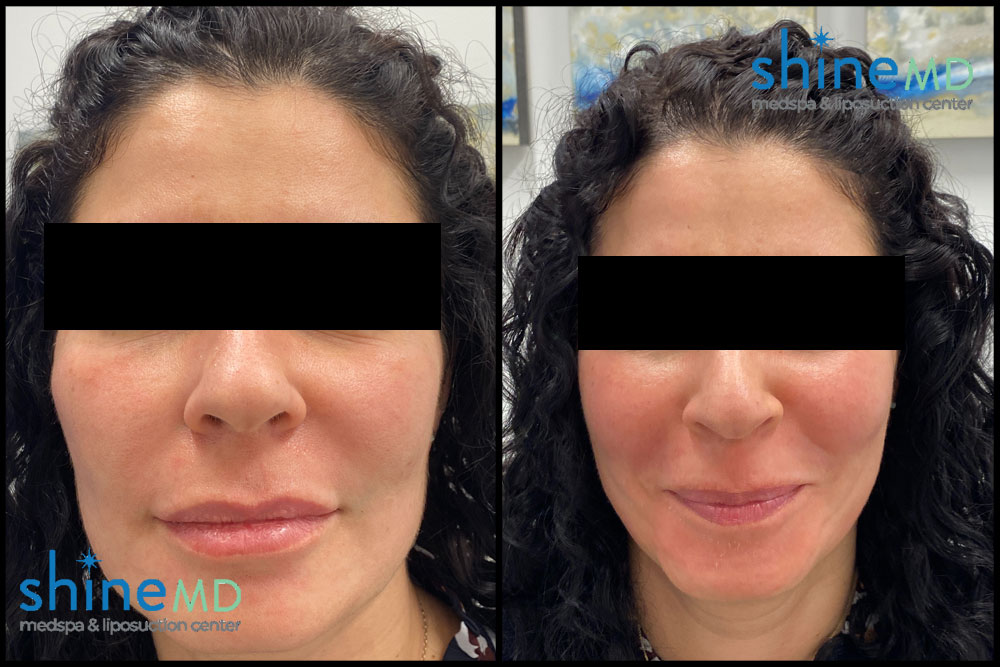 cool sculpting before and after chin