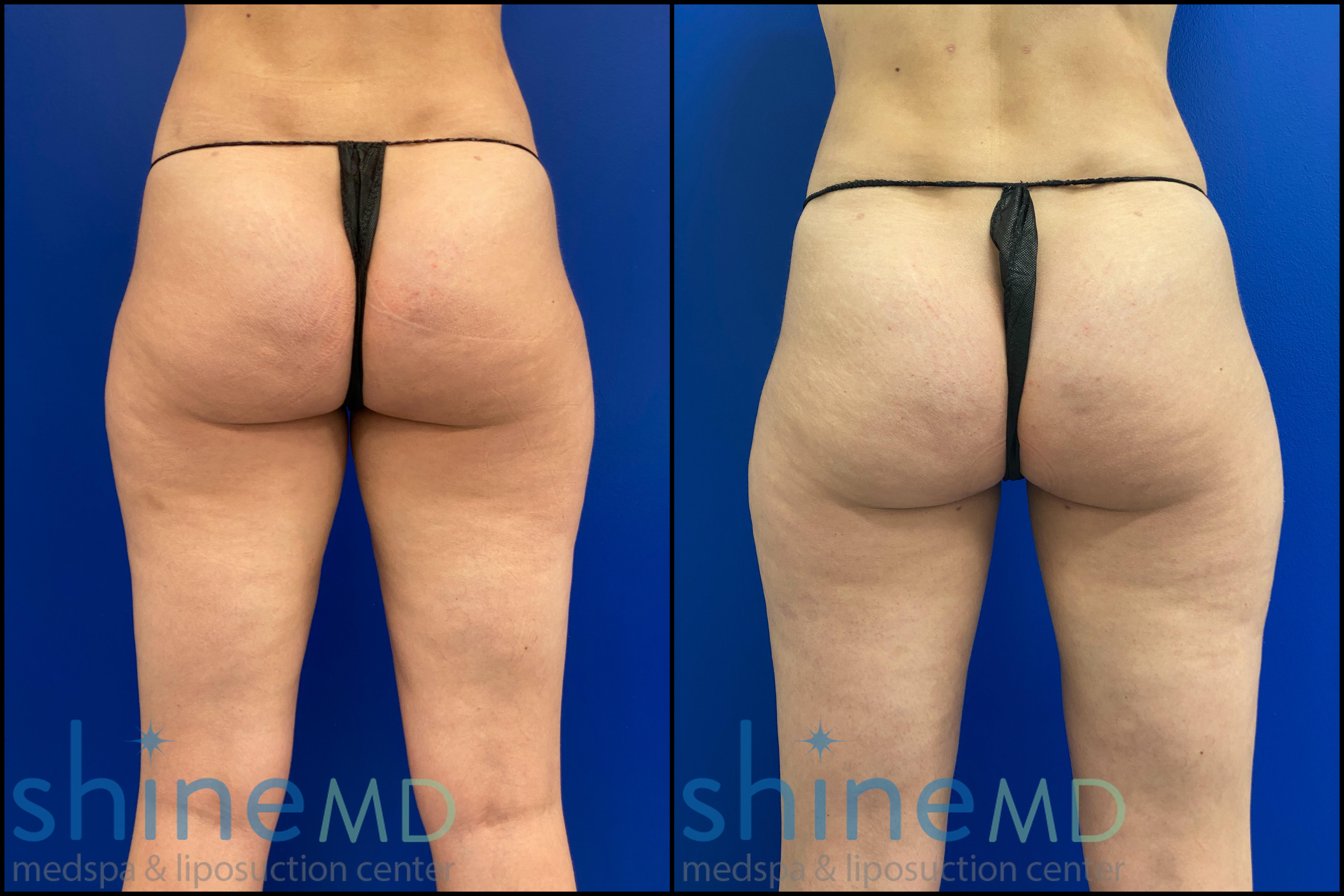 INNER THIGH LIPO